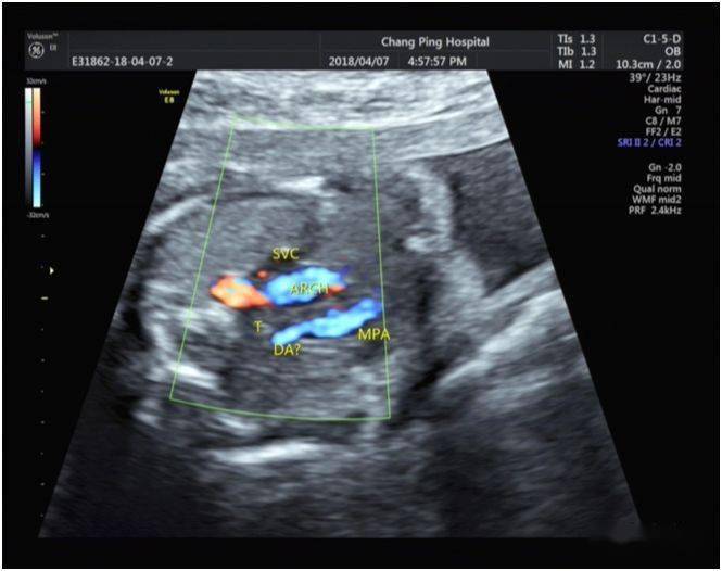 超声典型病例胎儿法洛四联症合并右位主动脉弓