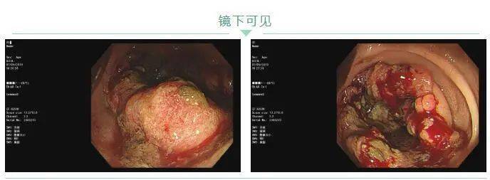 长期大便不成形别总盯着湿气要当心肠癌来敲门