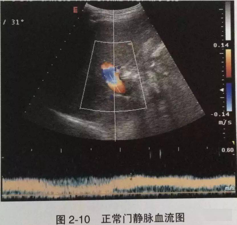 肝臟超聲診斷_門靜脈