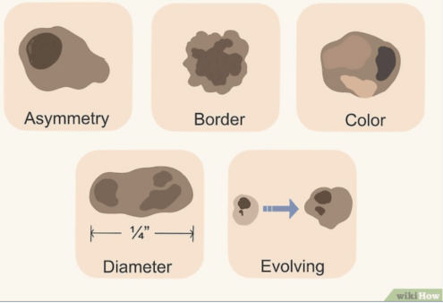 科普——同为有"痣"之士,你了解你的痣吗?