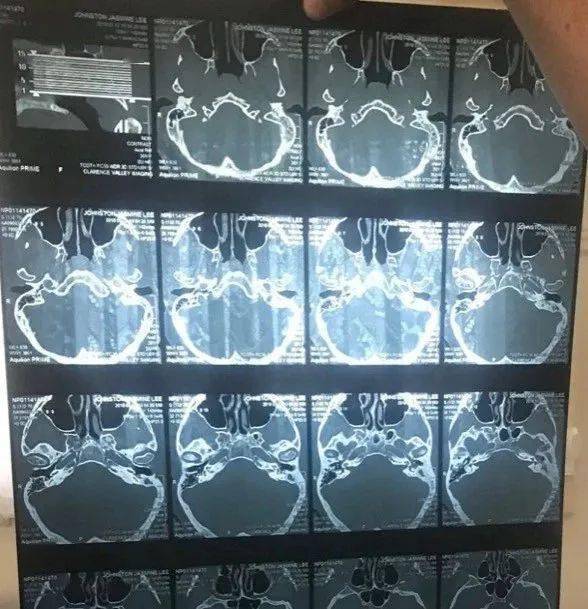 ct扫描显示,small的耳朵深处已被感染,这里非常靠近她的大脑.