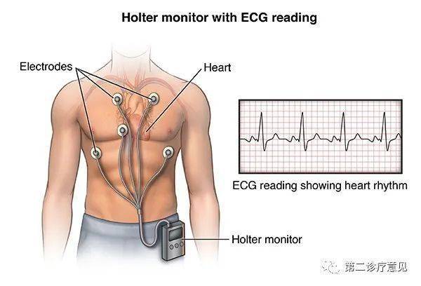 holter的好处是,可以进行多导联的心电监测,检查时间较长,24到48 小时