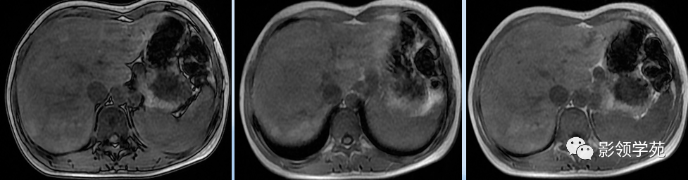 急性重型病毒性肝炎,肝肿大伴门脉周围水肿,边界欠清.