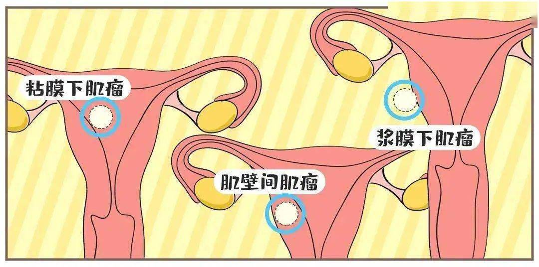 子宫肌瘤满大街,你害怕吗?