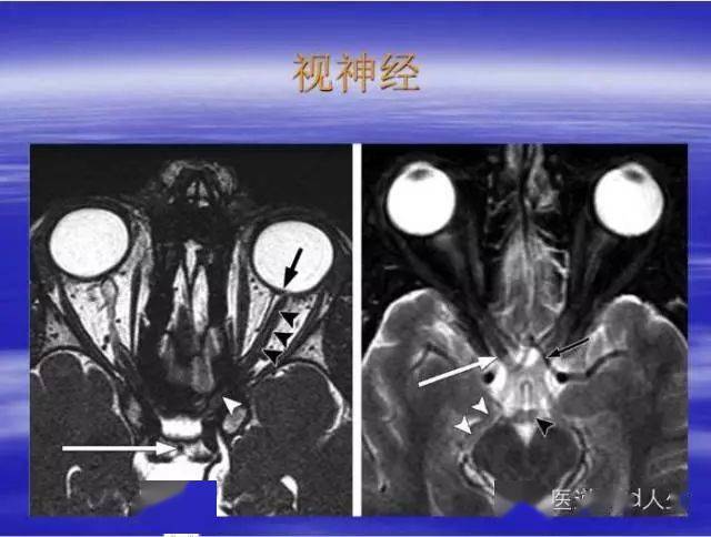 动眼神经mri影像解剖图图片