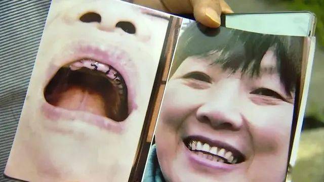 太坑了!好牙被拔完了