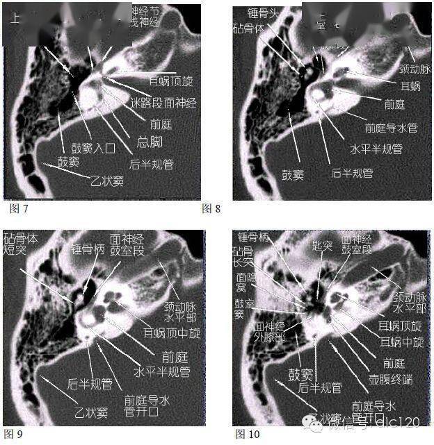 中耳乳突ct解剖图图片