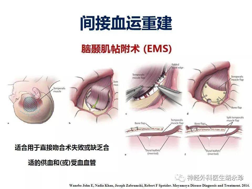 煙霧病的現況