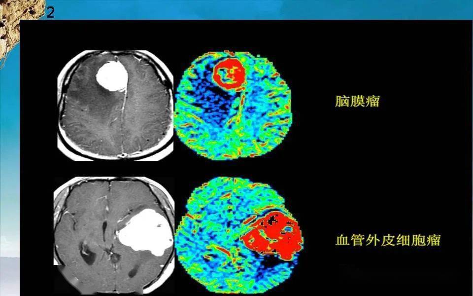 了解磁共振功能成像之灌注成像