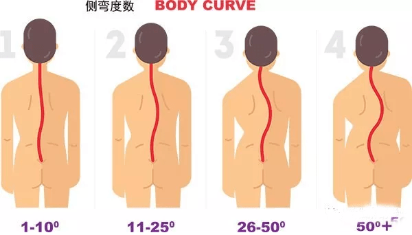 那麼,今天就從5個方面12個瑜伽動作,來治療和預防輕度脊柱側彎,還可以