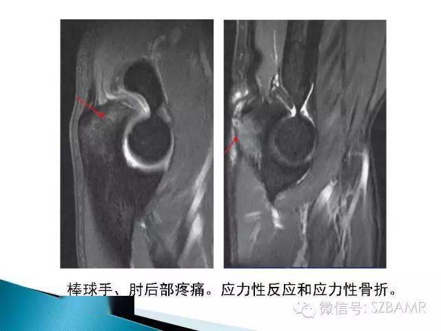 肘关节横断解剖图CT图片