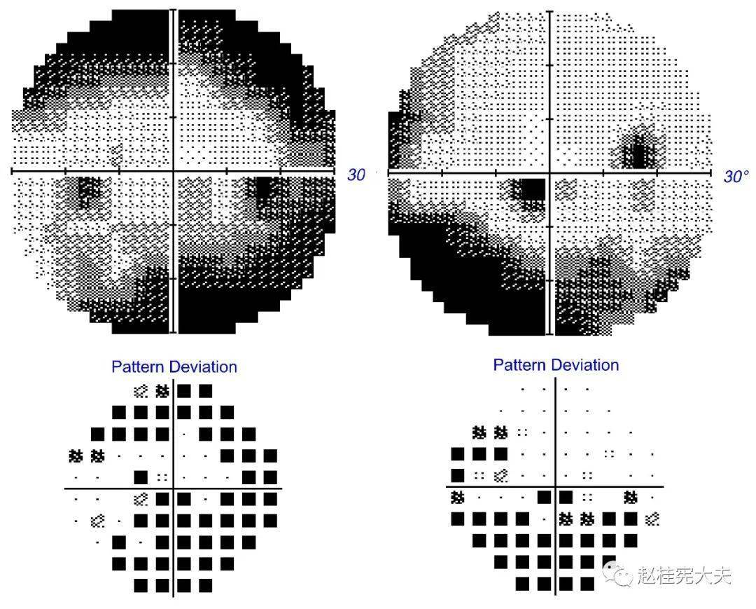 视野缺损图解图片