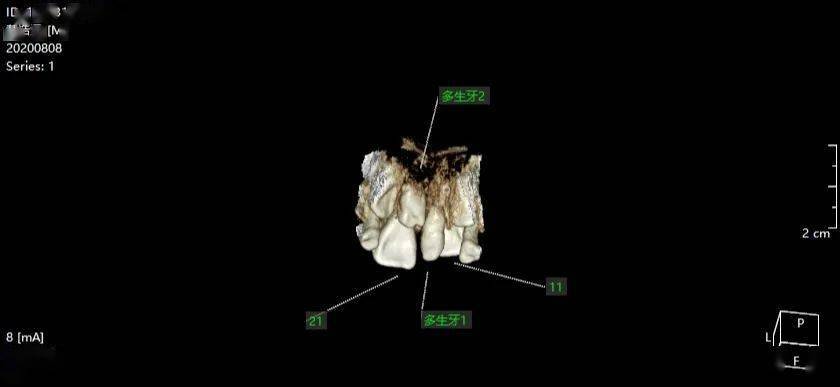 ct示:混合牙列,11 21間可見一錐形多生牙,緊鄰11近中牙冠,21顎側可見