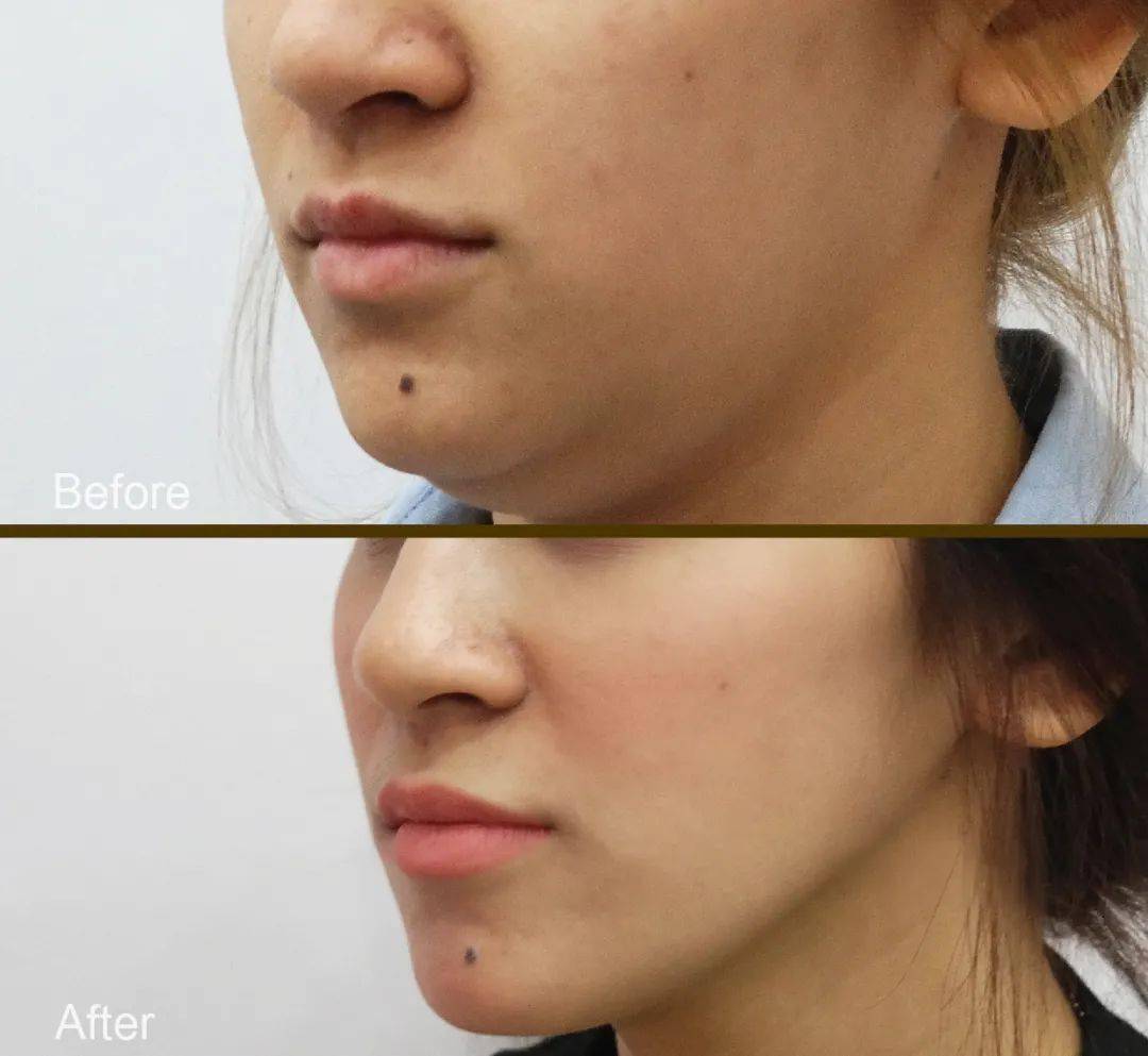 让脸部整体往上走 特殊的挂耳式设计 再将膜布造就的v脸轮廓固定 在短