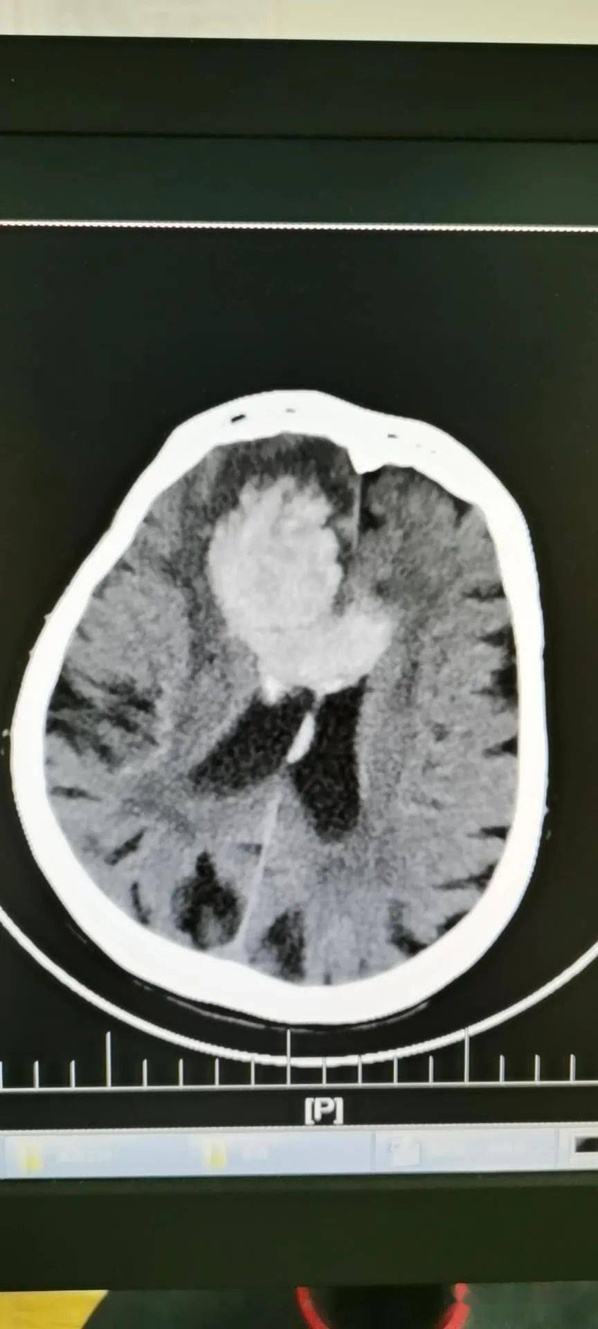 患者"风湿性脑嗖 心功能不全"病史多年,11年前在北京安贞医院行"