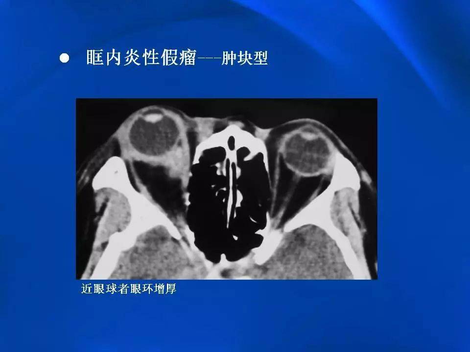 眶内炎性假瘤影像学表现