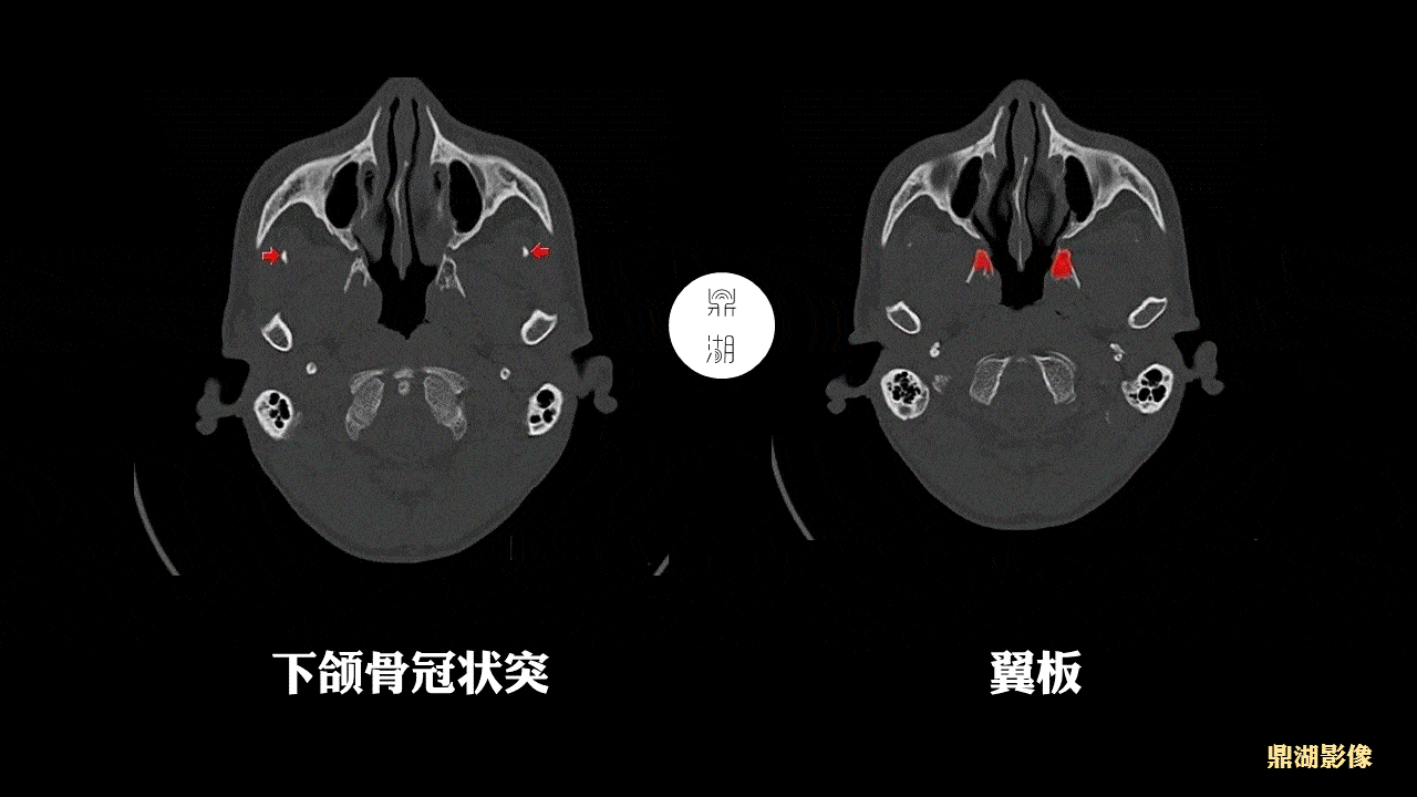 颅底详细断层解剖