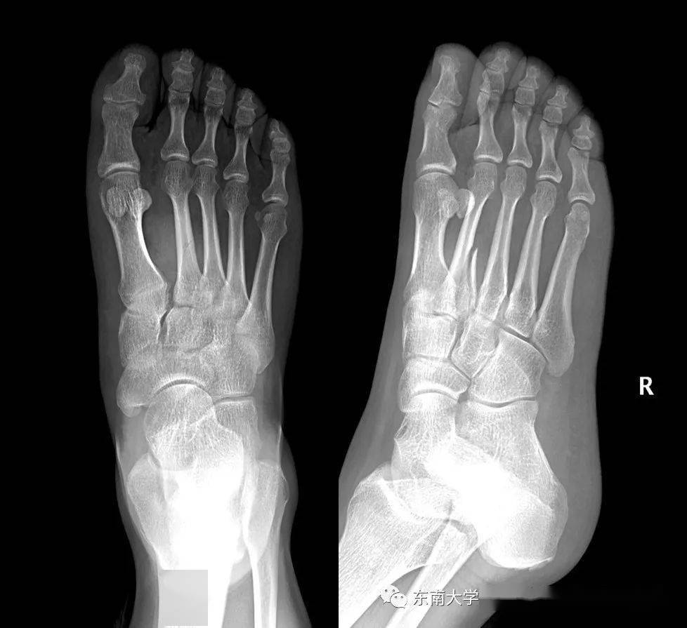 解读关于lisfranc损伤的4个知识点!_手机搜狐网