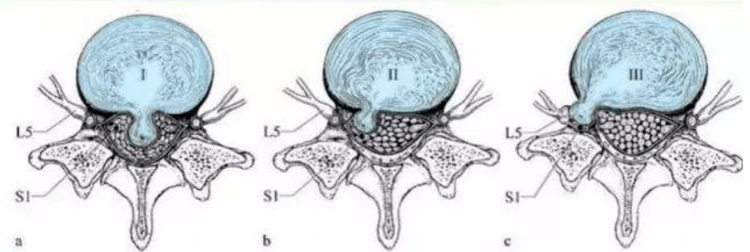 如圖所示將腰椎間盤突出分為膨出,突出,脫出及許莫氏結節;腰椎間盤