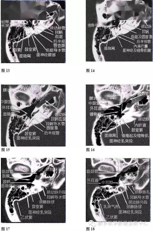 头颅冠状位图解图片