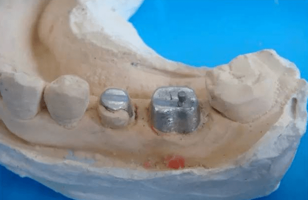 实际备牙产生的问题牙体预备中涉及的其他知识牙体解剖知识烤瓷牙