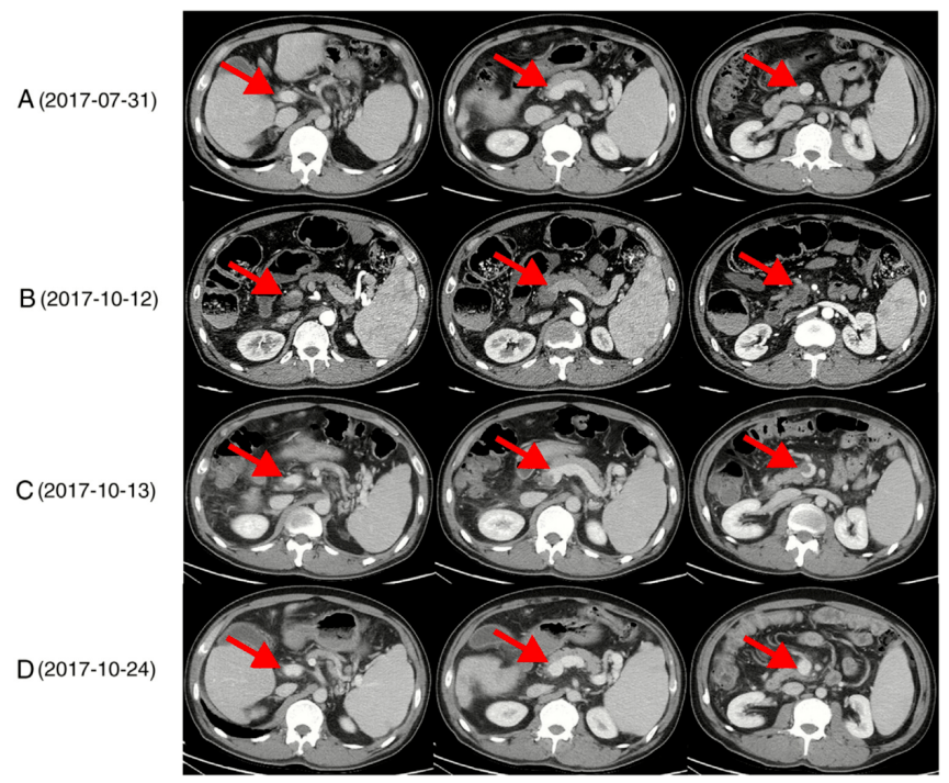 低分子肝素序贯利伐沙班治疗肝硬化急性,闭塞性门静脉-肠系膜上静脉