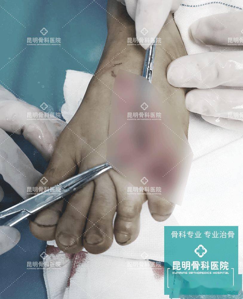 熊孩子玩菜刀失手砍伤左脚