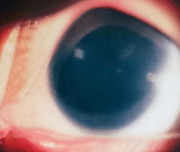 先天性无虹膜患者不再畏光向阳而生