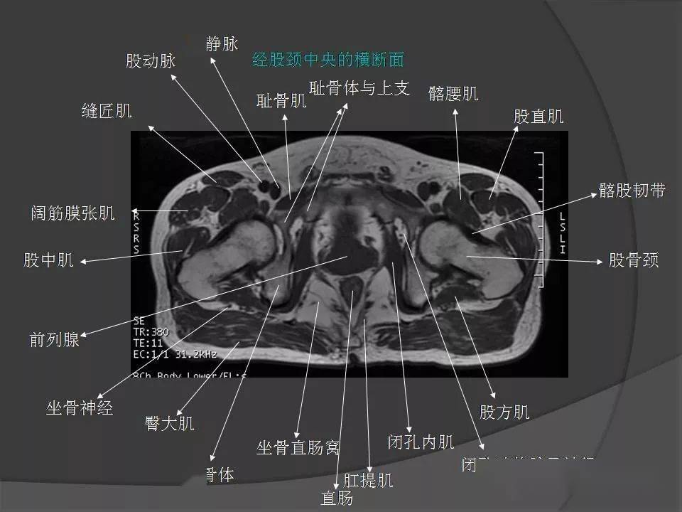 骨盆肌肉解剖mri標識_影像診斷中心