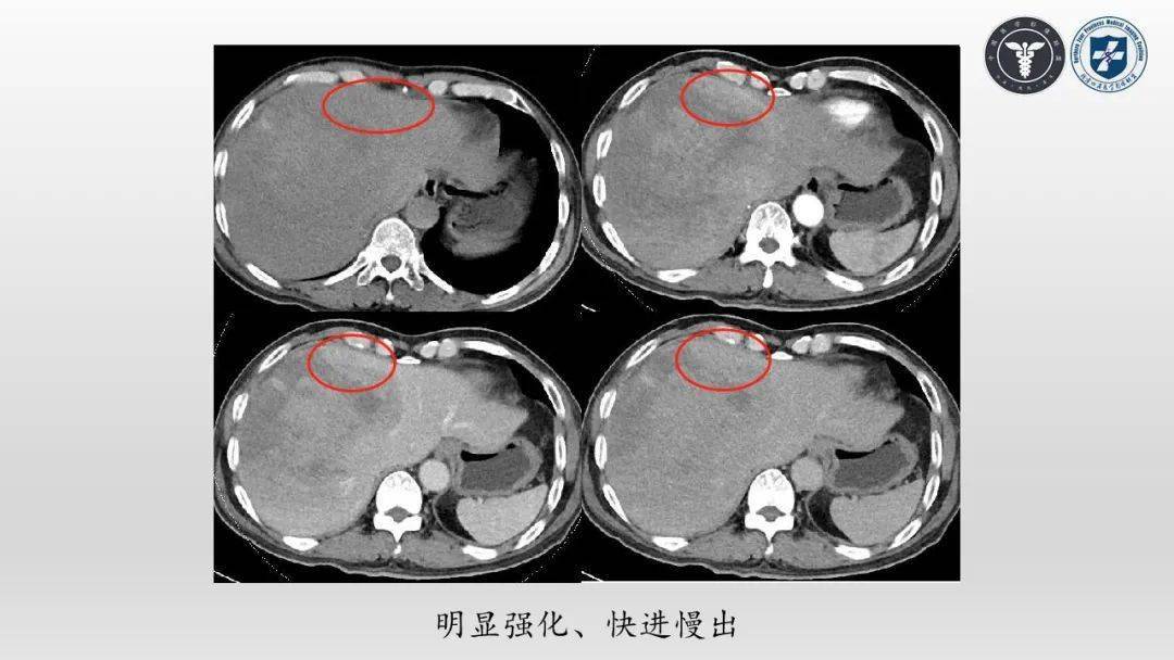 视频丨陈春茂肝脏转移性黑色素瘤病例分析