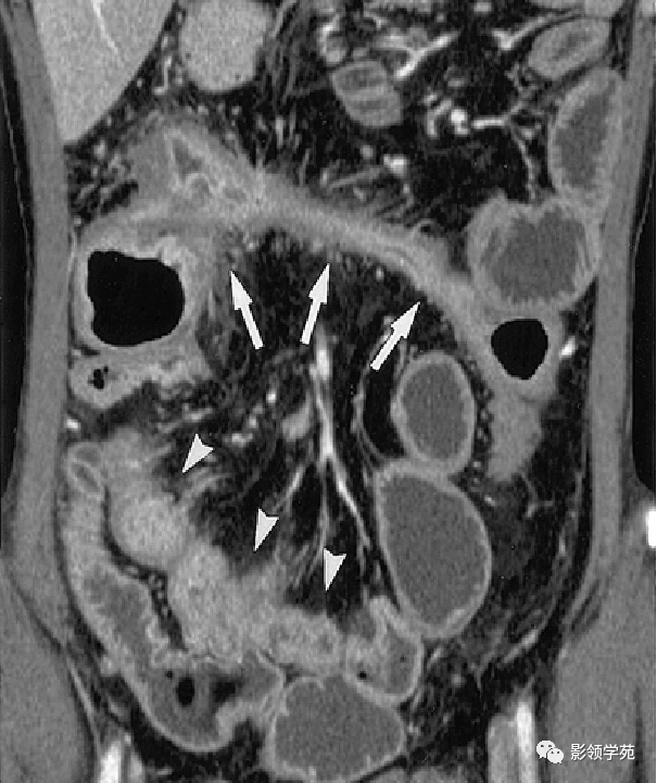 炎症性腸病的ct診斷_腸壁