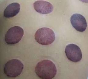 现象,表明患者寒加血淤症,轻重有差别;罐斑紫红或紫黑色,或出现丹痧