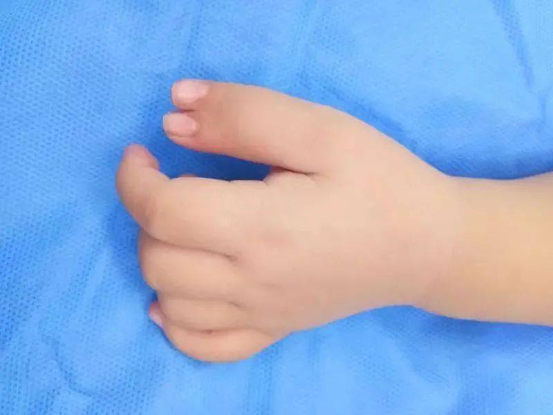 深圳丨一岁娃有两个拇指更吃惊的是这个家族六指竟是常态