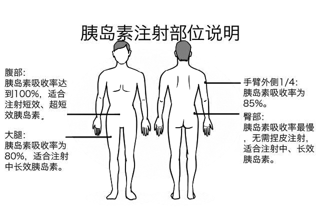 糖尿病打针部位图片