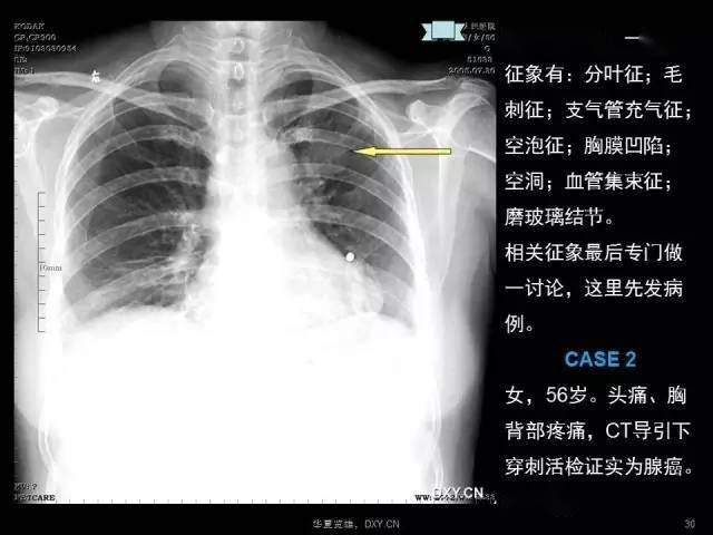 (重磅)肺癌,肺炎,肺结核的影像诊断鉴别