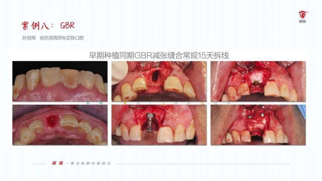 如何在拔牙後促進牙齦傷口癒合