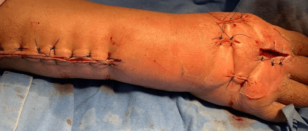 不想辜负海的味道小小伤口让手肿成锤子还大面积发紫