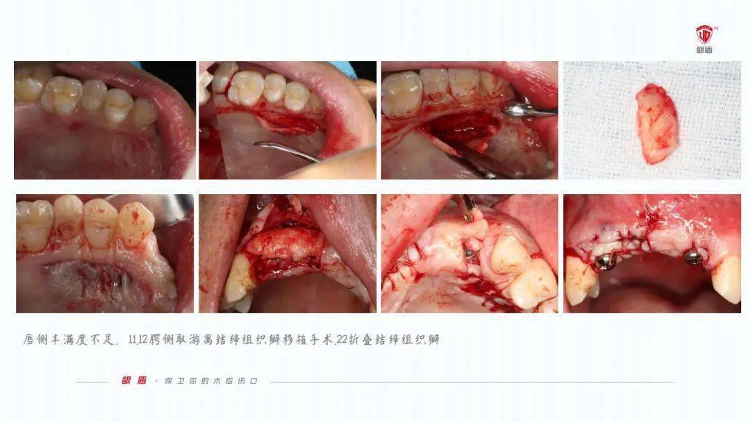 如何在拔牙后促进牙龈伤口愈合