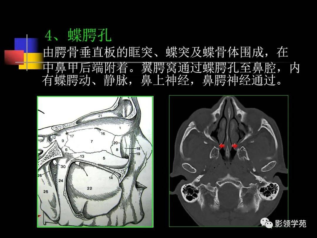 软腭CT解剖图片