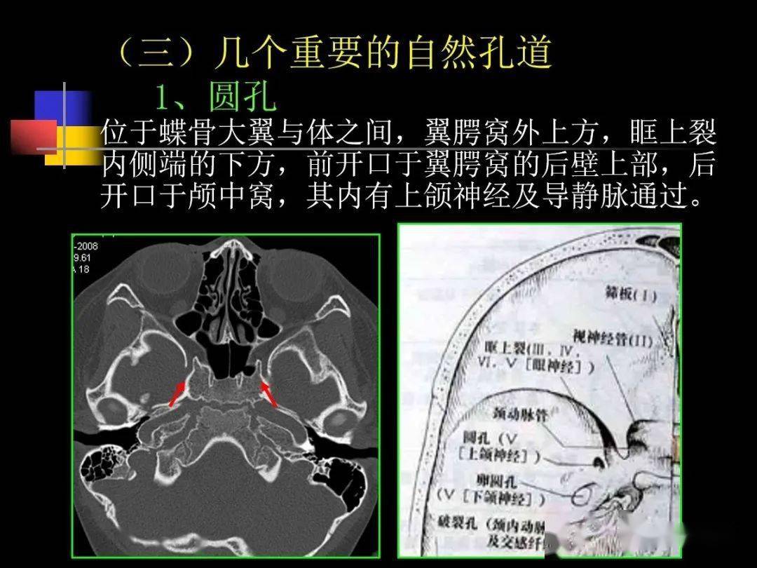 咽鼓管ct位置图片图片