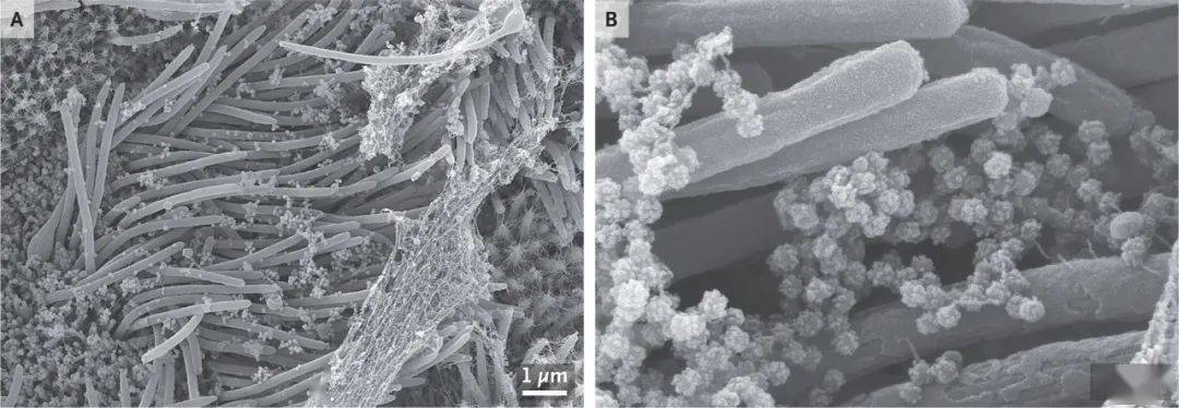 電鏡下被新冠病毒感染的呼吸道細胞什麼樣這可不是肉末粉絲