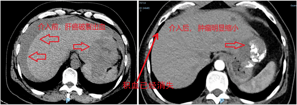 外科苑67突发晚期肝癌破裂大出血竟有机会治愈