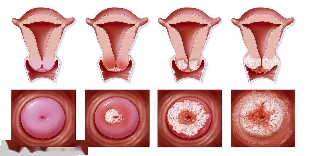 每日小知识:宫颈糜烂,为啥最容易"上脸"_女性