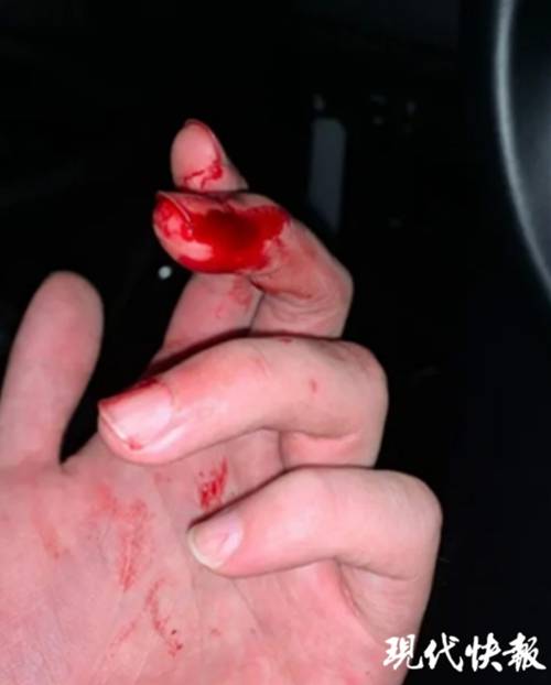 小偷持刀拒捕两民警多处被划伤