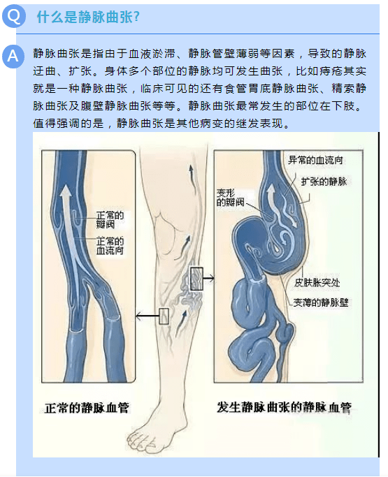 小隐静脉走行图片图片