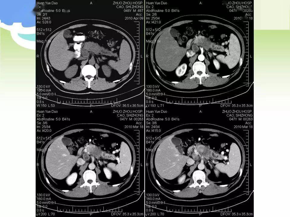 胰腺癌ct影像图图片