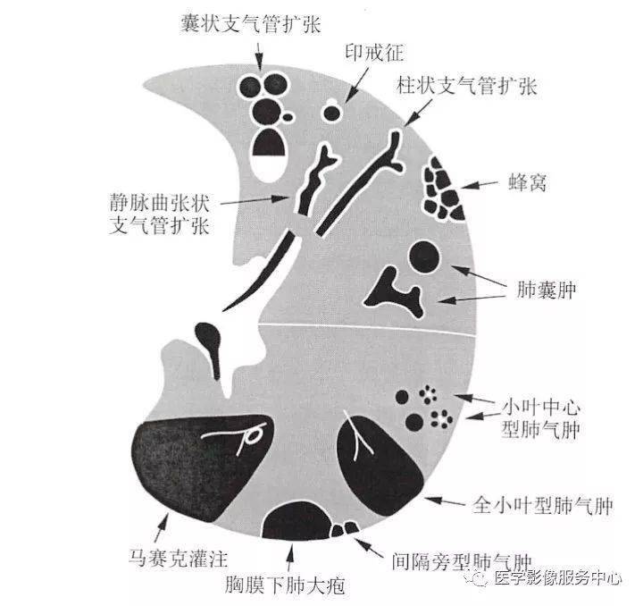 肺含气囊腔分类定义及ct诊断思维