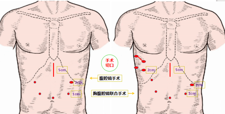 医声医事 听市一院李新宇主任讲胃贲门早癌的手术经