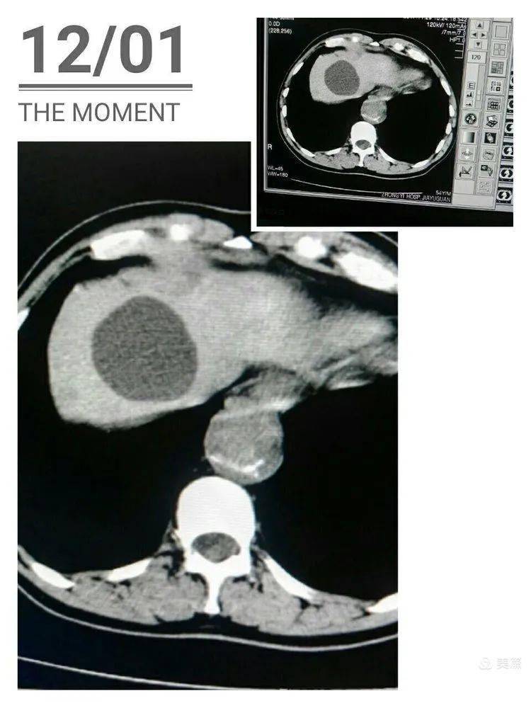 肝囊肿ct图片怎么看图片