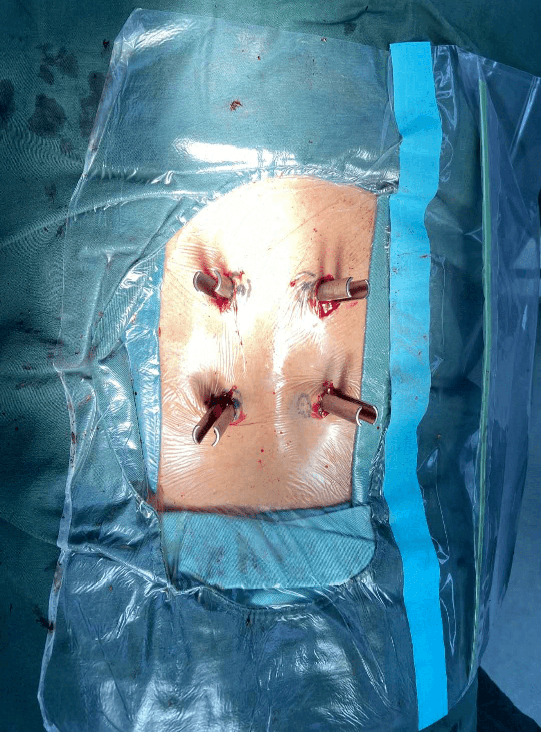 椎弓峡部裂手术图片图片
